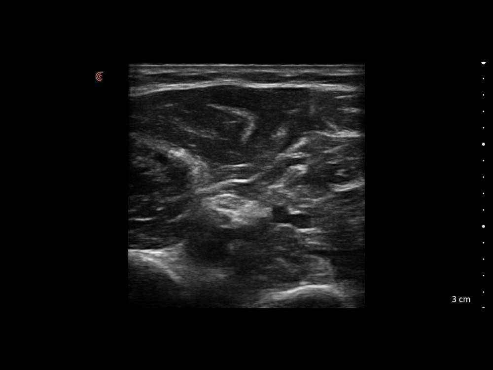 clarius-pal-hd3-nervus-ulnaris Clarius PAL HD3 Ultraschallbild des Nervus Ulnaris