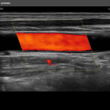 Alpinion X-CUBE i8 Ultraschallgerät Sonographie in Farbe