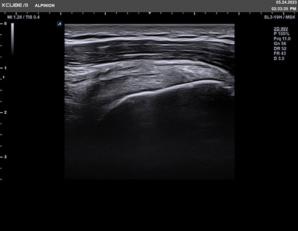 Alpinion X CUBE i9 Ultraschallgerät Sonographie Uterus