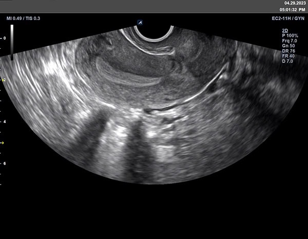 Alpinion X CUBE i9 Ultraschallgerät Sonographie Schulter