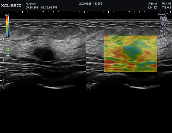 Alpinion X-CUBE 70 Elastographie