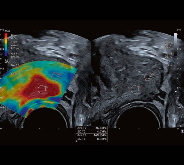 Canon Aplio a Ultraschallgerät UroEdition