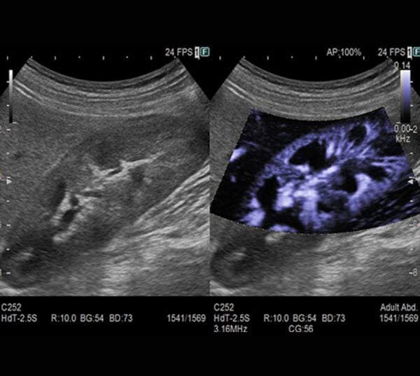 Fujifilm ARIETTA 650 DeepInsight Ultraschallgerät