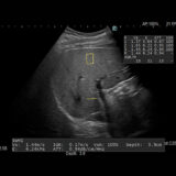 Fujifilm ARIETTA 650 DeepInsight Ultraschallgerät