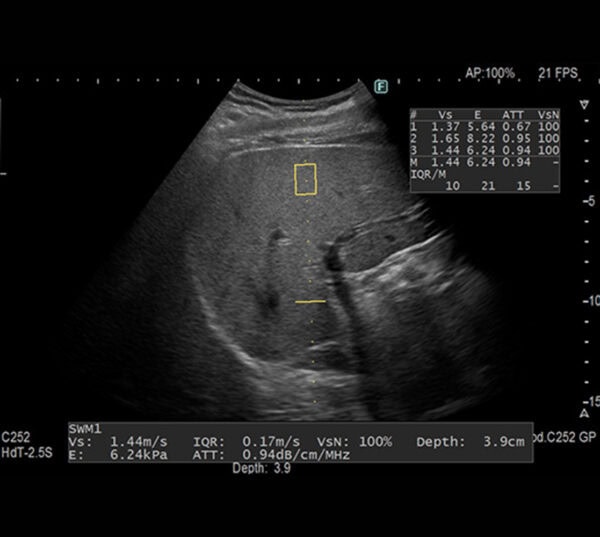 Fujifilm ARIETTA 650 DeepInsight Ultraschallgerät