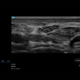 Fujifilm SonoSite LX Ultraschallgerät