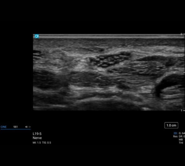 Fujifilm SonoSite LX Ultraschallgerät