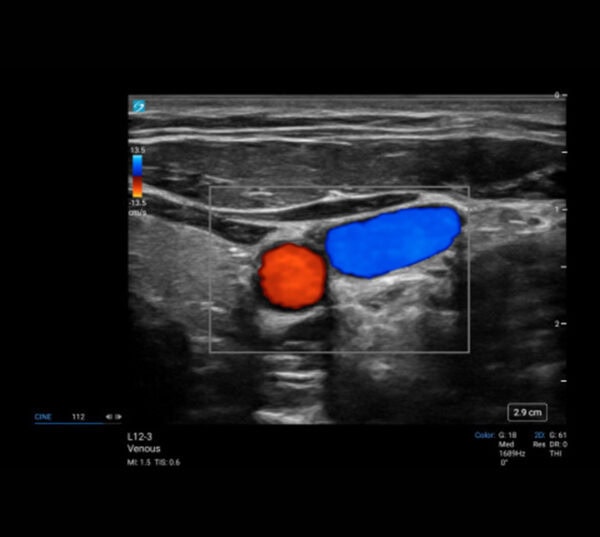 Fujifilm SonoSite LX Ultraschallgerät