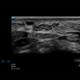 Fujifilm SonoSite PX Ultraschallgerät