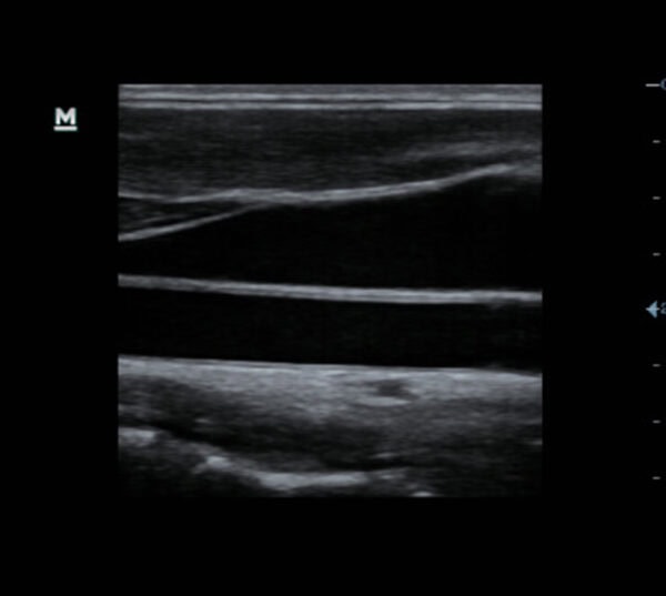 Mindray DP-50Exp Ultraschallgerät