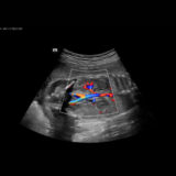 Mindray Nuewa I8 Ultraschallgerät