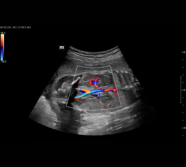 Mindray Nuewa I8 Ultraschallgerät