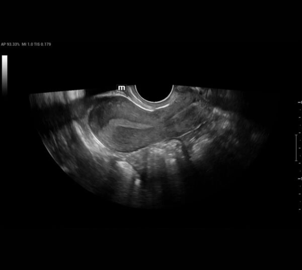 Mindray Nuewa I8 Ultraschallgerät