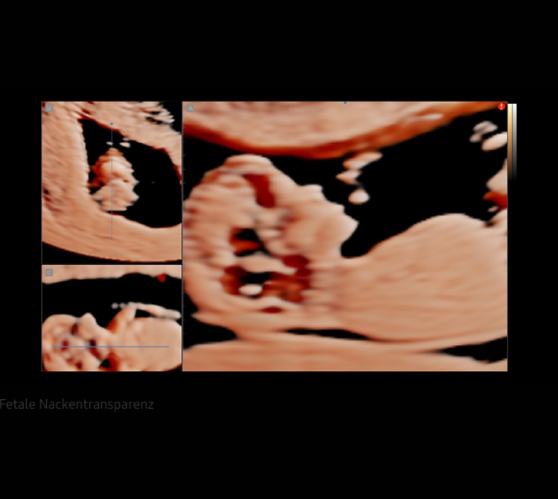 samsung-hera-hs50-ultraschallgeraete-6 Samsung HS50 Ultraschallgerät