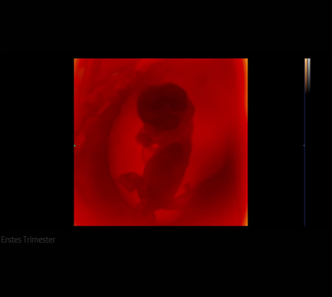 samsung-hera-hs50-ultraschallgeraete-7 Samsung HS50 Ultraschallgerät