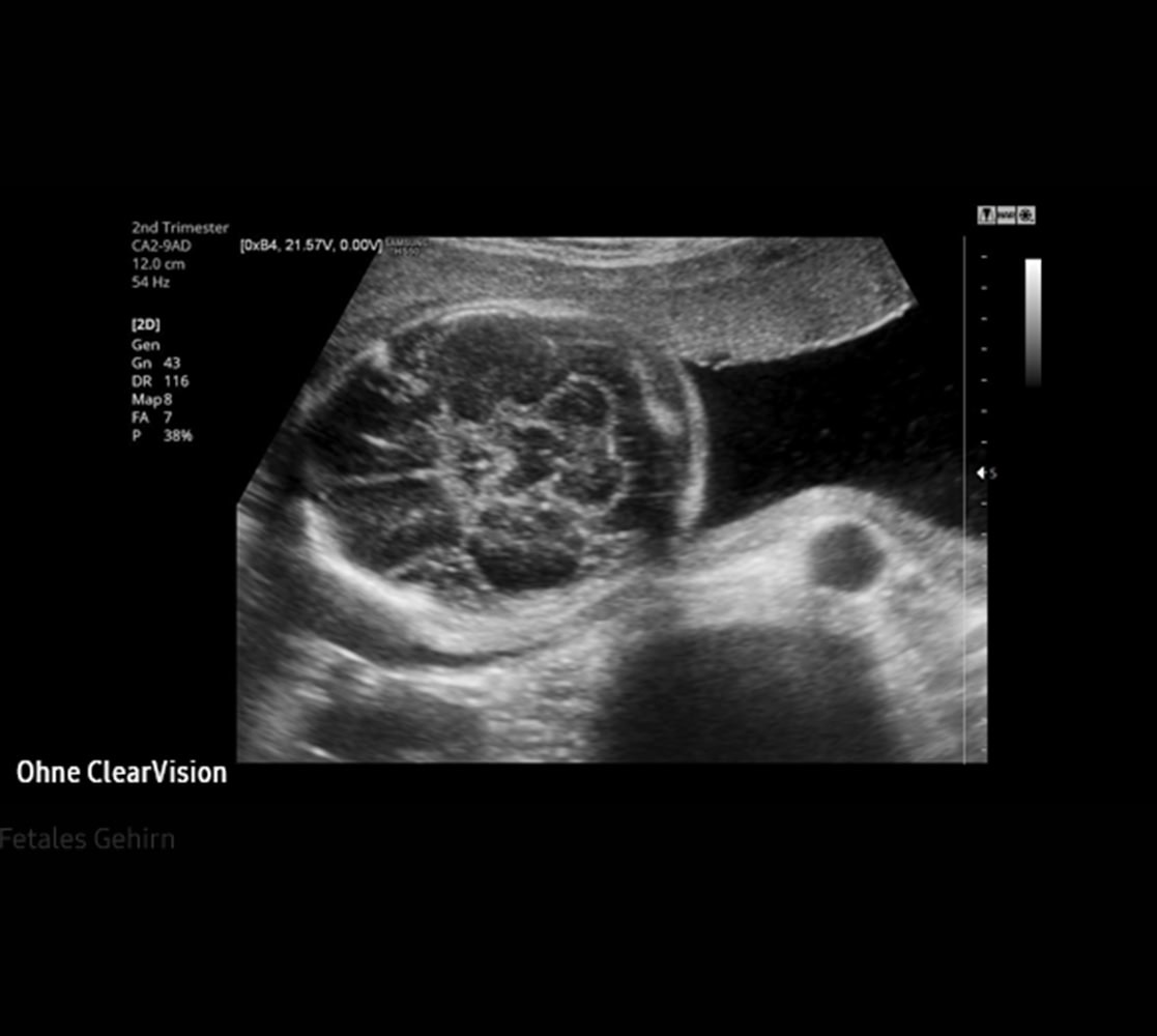 samsung-hera-hs50-ultraschallgeraete-8 Samsung HS50 Ultraschallgerät