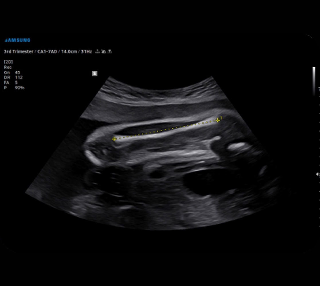Samsung V6 Ultraschallgerät