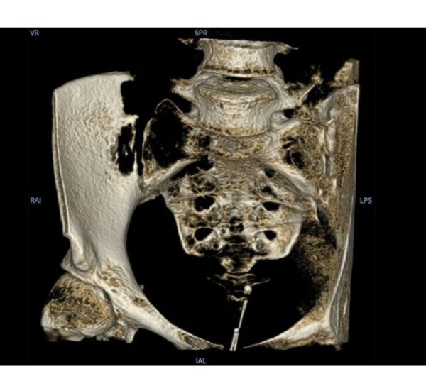 GE HealthCare OEC 3D C-Bogen