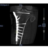 GE HealthCare OEC 3D C-Bogen