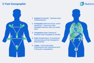 Schematische Darstellung der E-Fast Sonographie mit markierten Untersuchungsbereichen zur Detektion freier Flüssigkeit im Körper.