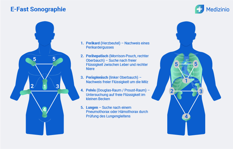 Schematische Darstellung der E-Fast Sonographie mit markierten Untersuchungsbereichen zur Detektion freier Flüssigkeit im Körper.