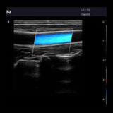 Edan Acclarix AX2 Ultraschallgerät