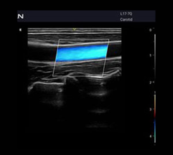 Edan Acclarix AX3 Ultraschallgerät