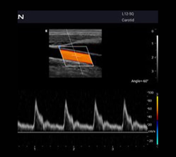 Edan Acclarix AX3 Ultraschallgerät