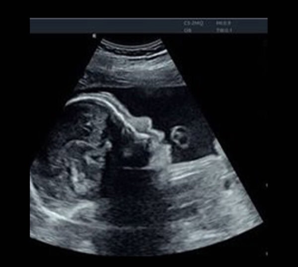 Edan Acclarix AX8 Ultraschallgerät