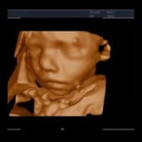 Edan Acclarix AX8 Ultraschallgerät