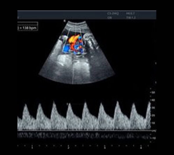 Edan Acclarix AX8 Ultraschallgerät