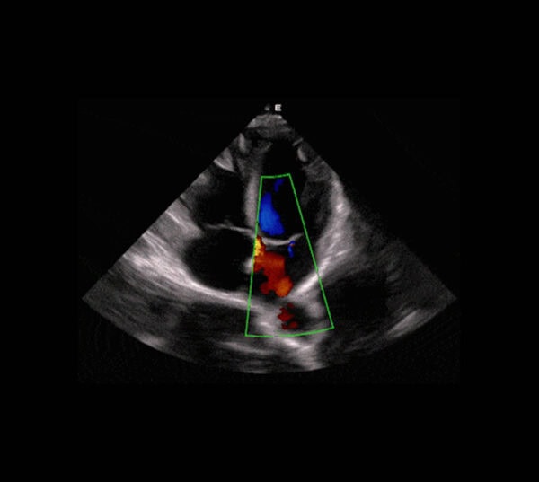Edan Acclarix LX9 Ultraschallgerät