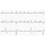Edan PADEKG EKG-Gerät