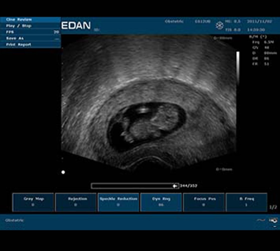 Edan U50 Ultraschallgerät