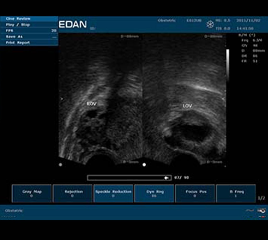 Edan U50 Ultraschallgerät