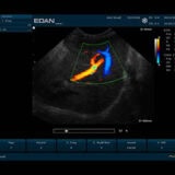 Edan U50 VET Ultraschallgerät