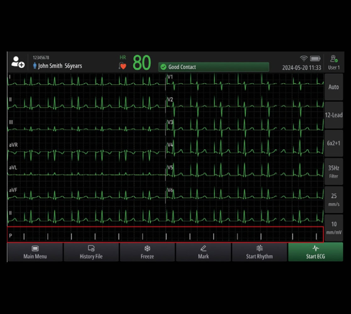 mindray-beneheart-r700-ekggeraete-1 Mindray BeneHeart R700 EKG-Gerät