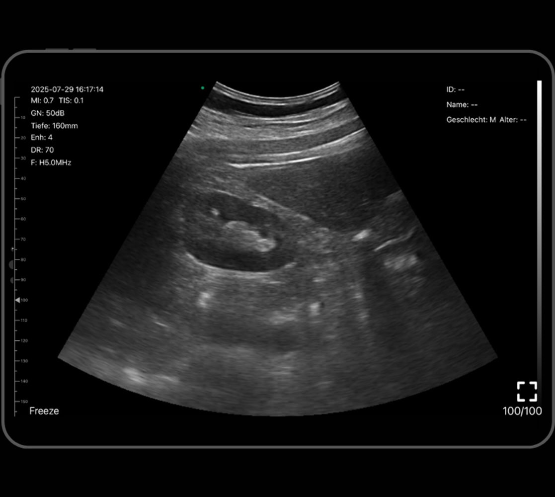 moons-atlas-handheld-ultraschallgeraet-ultraschallbild-2 Moons Atlas Handheld-Ultraschallgerät (Doppelkopf) Ultraschallbild