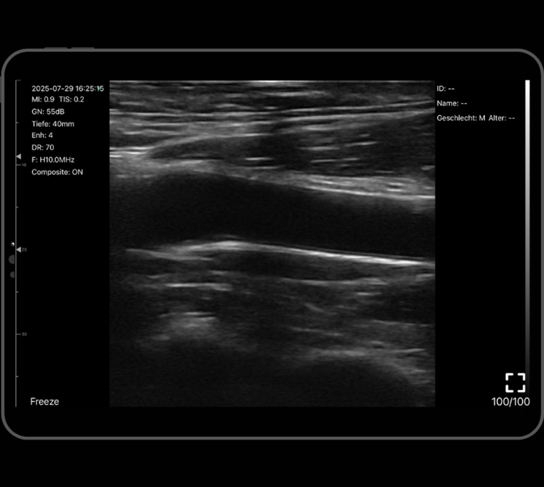 moons-atlas-handheld-ultraschallgeraet-ultraschallbild Moons Atlas Handheld-Ultraschallgerät (Doppelkopf) Ultraschallbild