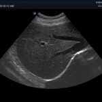Darstellung des Abdomen mit einem Alpinion minisono