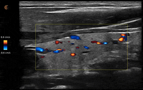 Clarius HD Handheld Ultraschallbilder einer Schilddrüse