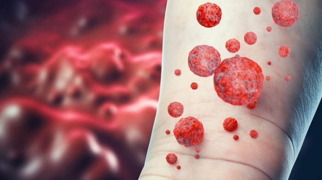 blood-cancer-skin-rash-symptoms-causes-and-treatments