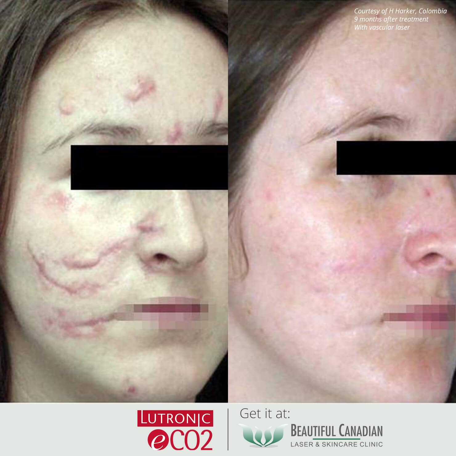 Vancouver Fractional CO2 Laser Skin Resurfacing Surrey, Delta, Langley