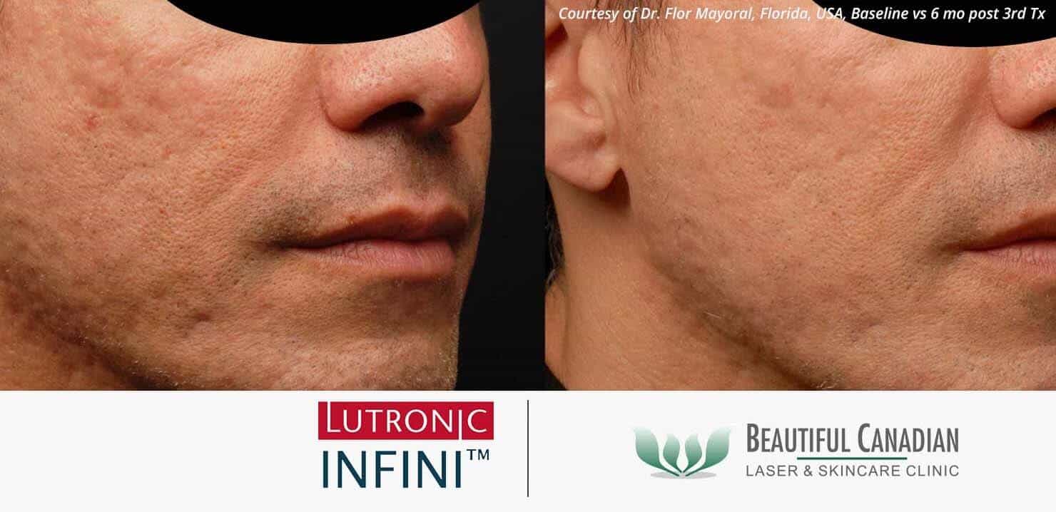 Acne Scar Treatment Vancouver (Surrey) with Lasers, Surgeries, Facials