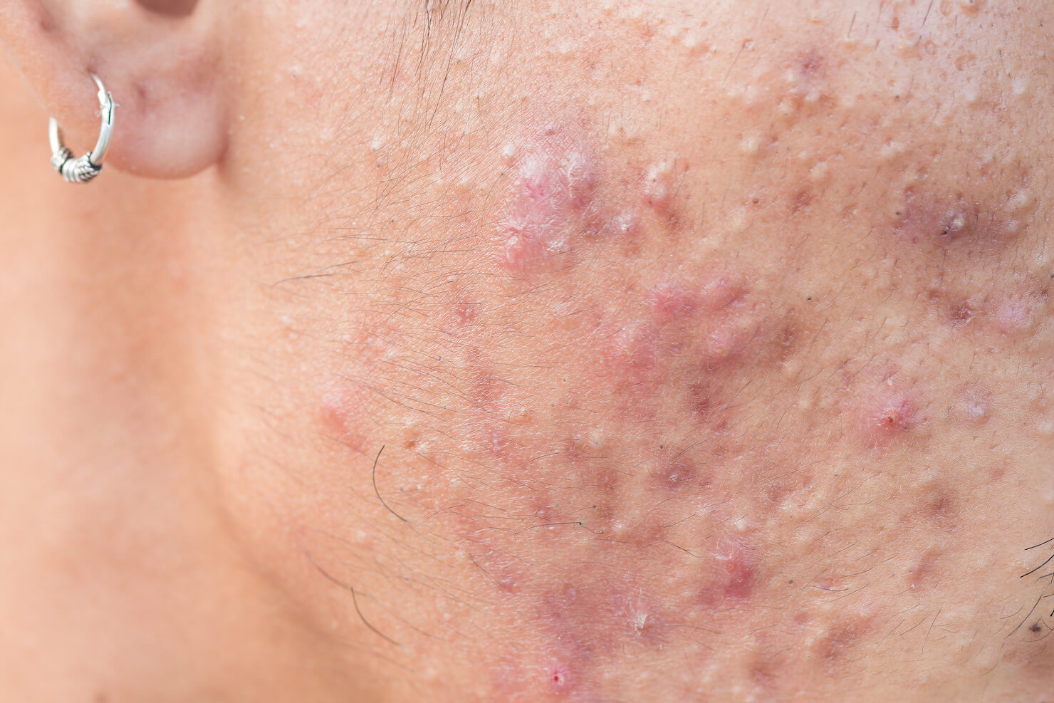 Acne Scar Treatment Vancouver (Surrey) with Lasers, Surgeries, Facials