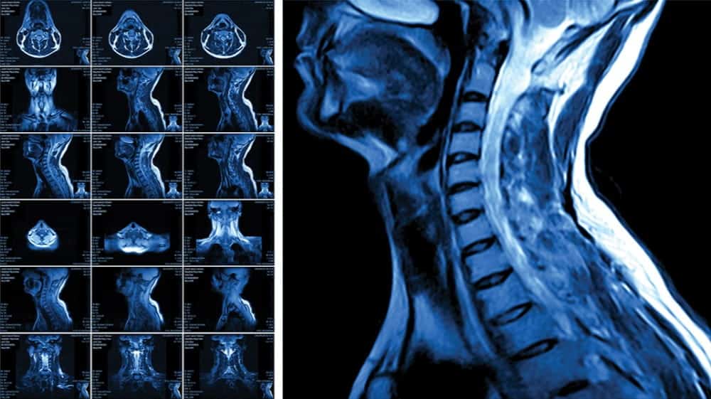 MRI scans of the cervical spine are shown in multiple cross-sectional views on the left and a sagittal view on the right, highlighting vertebrae and spinal cord. This advanced imaging exemplifies Seattle health and fitness trends, where early detection and prevention support overall wellness.