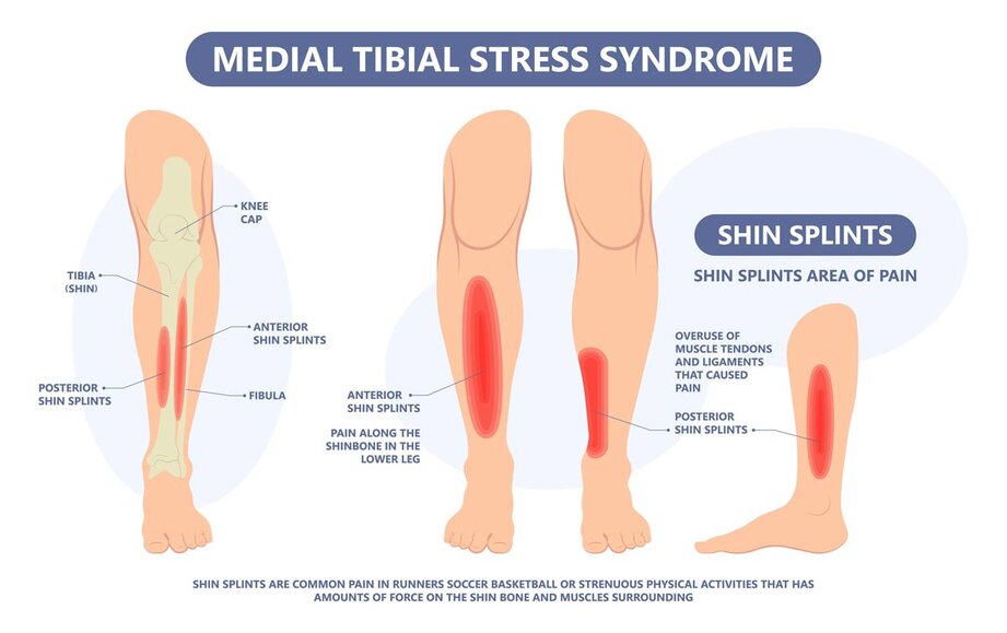 Shin Injury Recovery Time