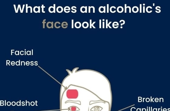whatdoesanalcoholicsfacelooklike small