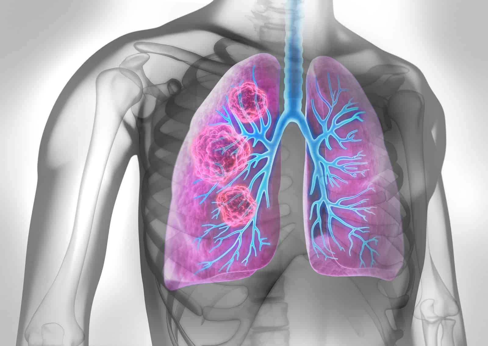 medical-illustration-of-lung-cancer-cancerous-area-in-lungs