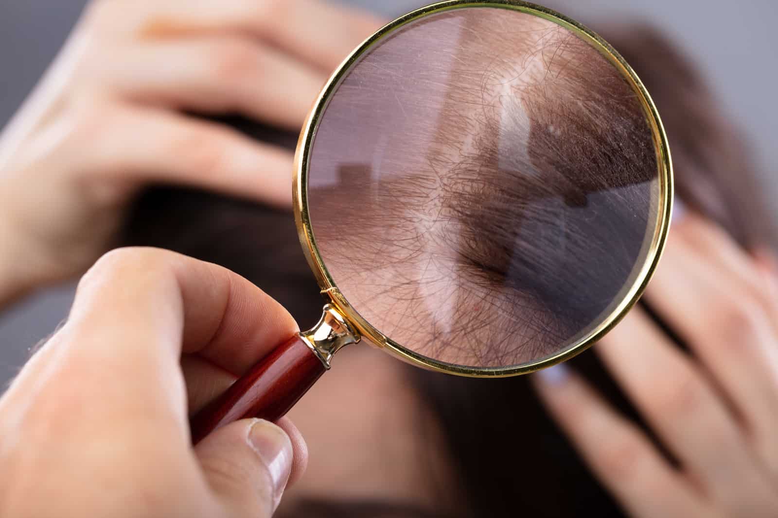 dermatologists-hand-examining-womans-hair-with-magnifying-glass